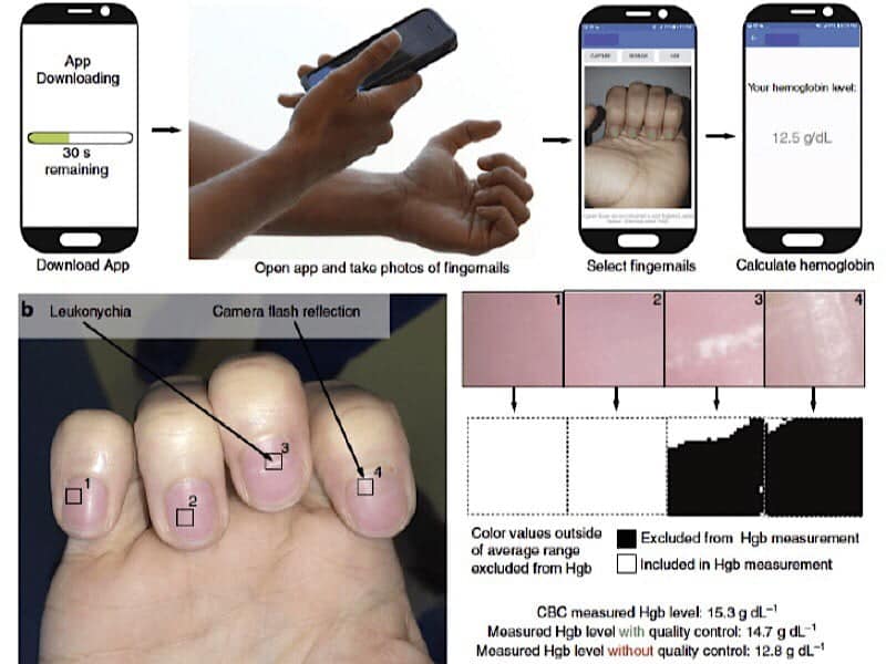 Une nouvelle application pour smartphone détectera l'anémie uniquement à travers vos ongles